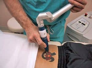 Laser Tattoo Removal - Q- Switched alexandrite laser