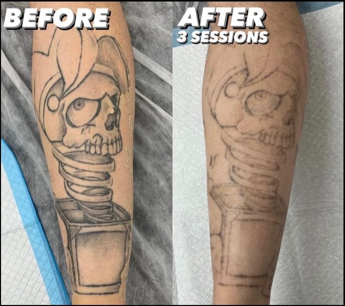 laser tattoo removal before and after