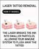 how laser removal tattoo works