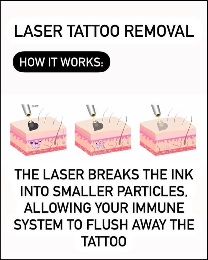 how laser removal tattoo works
